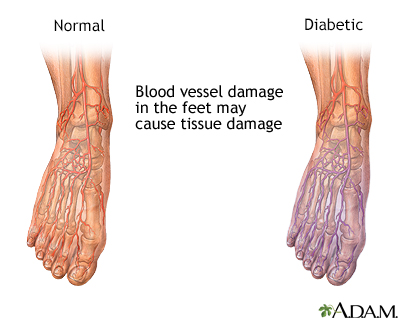 Diabetic blood circulation in foot - Illustration Thumbnail                      