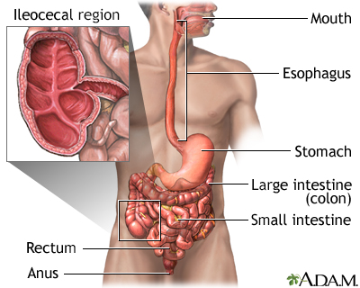 Crohn disease - affected areas - Illustration Thumbnail                      