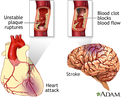 Plaque buildup in arteries - Illustration Thumbnail                      
