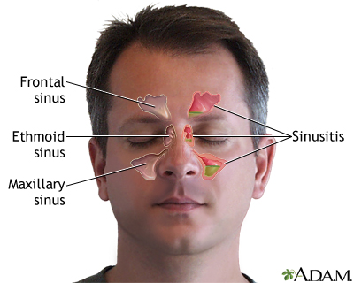 Sinusitis - Illustration Thumbnail                      