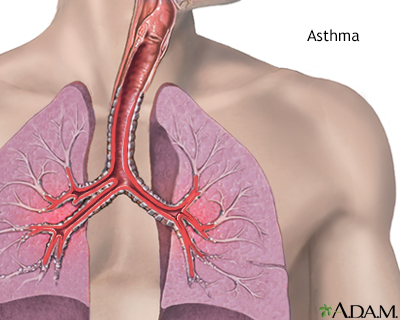 Asthma - Illustration Thumbnail                      