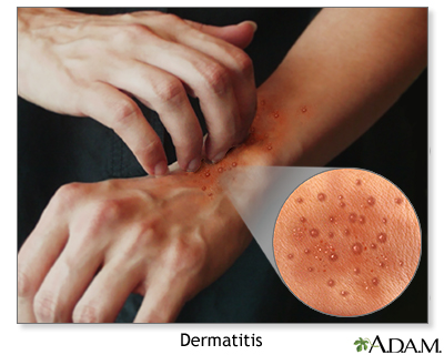 Atopic dermatitis - Illustration Thumbnail                      