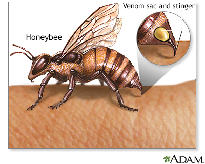 Insect stings and allergy - Illustration Thumbnail                      