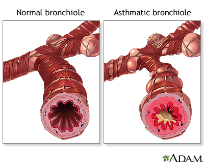 Normal versus asthmatic bronchiole - Illustration Thumbnail                      