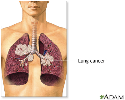 Secondhand smoke and lung cancer - Illustration Thumbnail                      