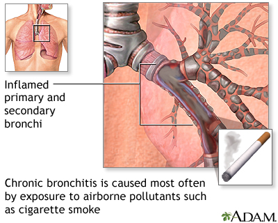 Causes of chronic bronchitis - Illustration Thumbnail                      