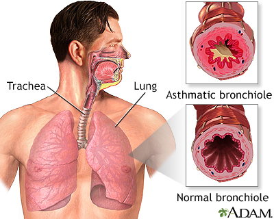 Asthmatic bronchiole and normal bronchiole - Illustration Thumbnail                      