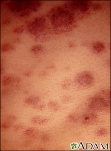 Acute monocytic leukemia - skin - Illustration Thumbnail                      