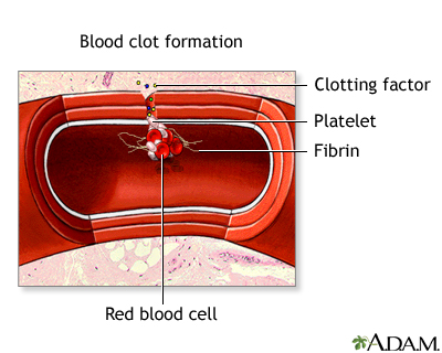 Blood clot formation - Illustration Thumbnail                      