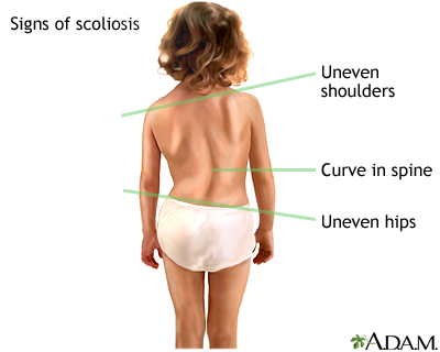 Signs of scoliosis - Illustration Thumbnail                      