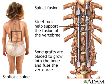 Spinal fusion - Illustration Thumbnail                      