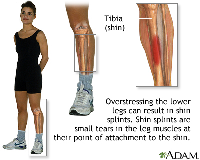 Shin splints - Illustration Thumbnail                      