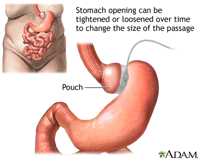 Adjustable gastric banding - Illustration Thumbnail                      