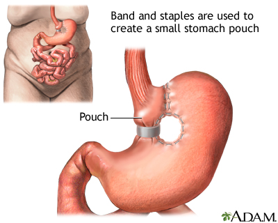 Vertical banded gastroplasty - Illustration Thumbnail                      