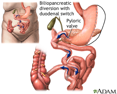 Biliopancreatic diversion with duodenal switch - Illustration Thumbnail                      
