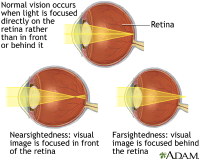 Normal, nearsightedness, and farsightedness - Illustration Thumbnail                      