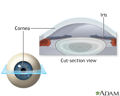 Lasik eye surgery - series - Normal anatomy - Presentation Thumbnail                    