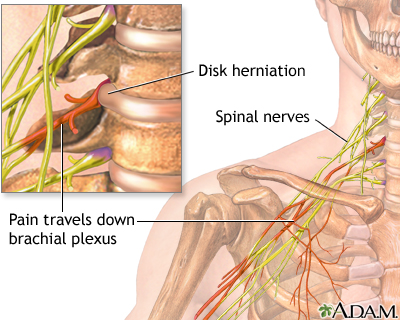 Neck pain - Illustration Thumbnail                      
