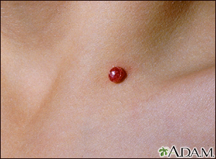 Pyogenic granuloma - close-up - Illustration Thumbnail                      