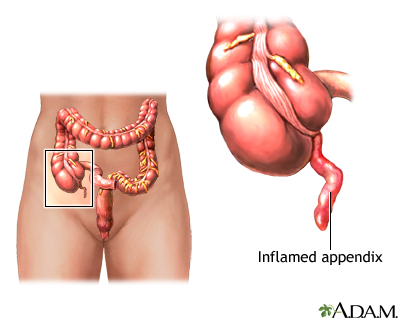 Appendicitis - Illustration Thumbnail                      
