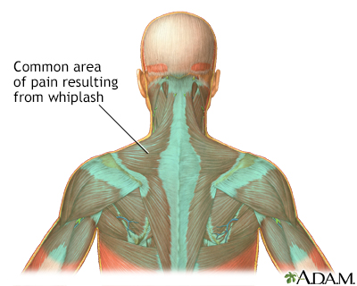 Location of whiplash pain - Illustration Thumbnail                      