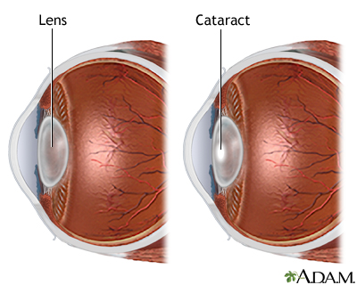 Cataract - Illustration Thumbnail                      