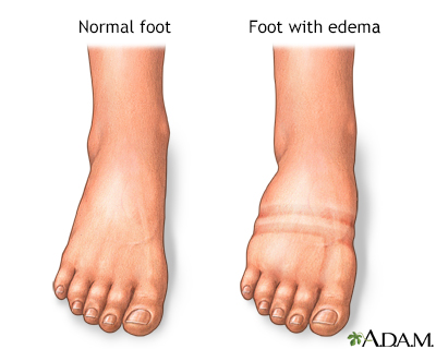Foot swelling - Illustration Thumbnail                      