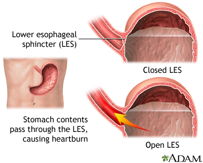 Gastroesophageal reflux disease - Illustration Thumbnail                      