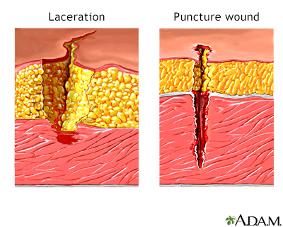 Laceration versus puncture wound - Illustration Thumbnail                      