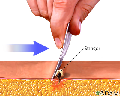Stinger removal - Illustration Thumbnail                      