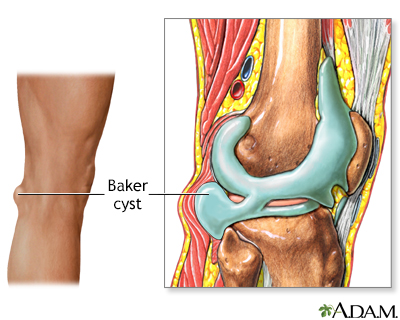 Baker cyst - Illustration Thumbnail                      
