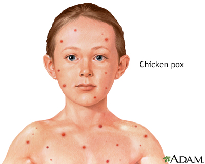 Chickenpox - Illustration Thumbnail                      
