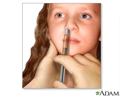 Nasal spray flu vaccine - Illustration Thumbnail                      