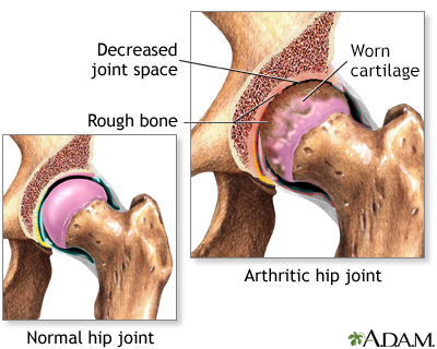 Arthritis in hip - Illustration Thumbnail                      