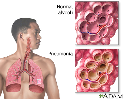 Pneumonia - Illustration Thumbnail                      