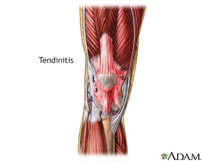Tendinitis - Illustration Thumbnail                      