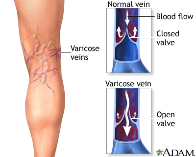 Varicose veins - Illustration Thumbnail                      