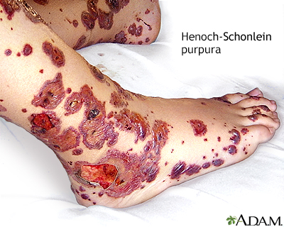 Henoch-Schonlein purpura - Illustration Thumbnail                      