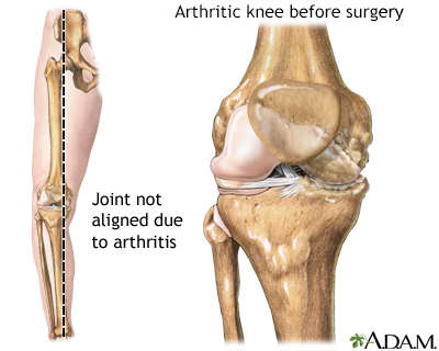 Knee misaligned due to arthritis