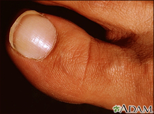White nail syndrome - Illustration Thumbnail                      