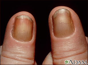 Yellow nail syndrome - Illustration Thumbnail                      