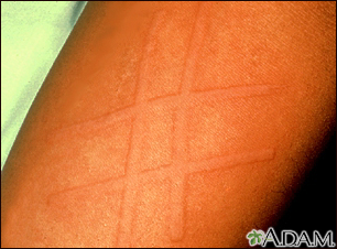 Dermatographism on the arm - Illustration Thumbnail                      