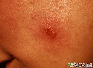 Leishmaniasis, mexicana - lesion on the cheek - Illustration Thumbnail                      