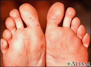 Hand, foot, and mouth disease on the soles - Illustration Thumbnail                      
