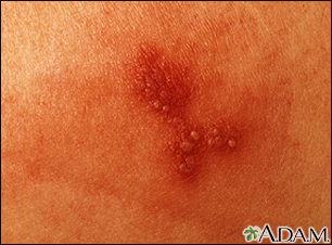 Herpes simplex - close-up - Illustration Thumbnail                      