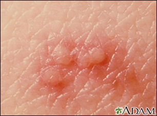 Herpes zoster (shingles) - close-up of lesion - Illustration Thumbnail                      