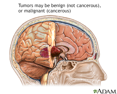 Brain tumor - Illustration Thumbnail                      