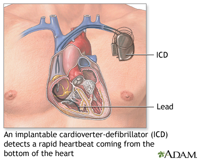 Implantable cardioverter-defibrillator - Illustration Thumbnail                      