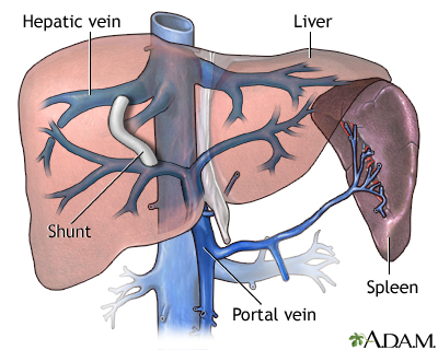 Transjugular intrahepatic portosystemic shunt - Illustration Thumbnail                      