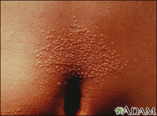 Lichen nitidus on the abdomen - Illustration Thumbnail                      
